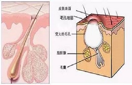 毛孔粗大原因有哪些？沈阳美容学校喊你来学习